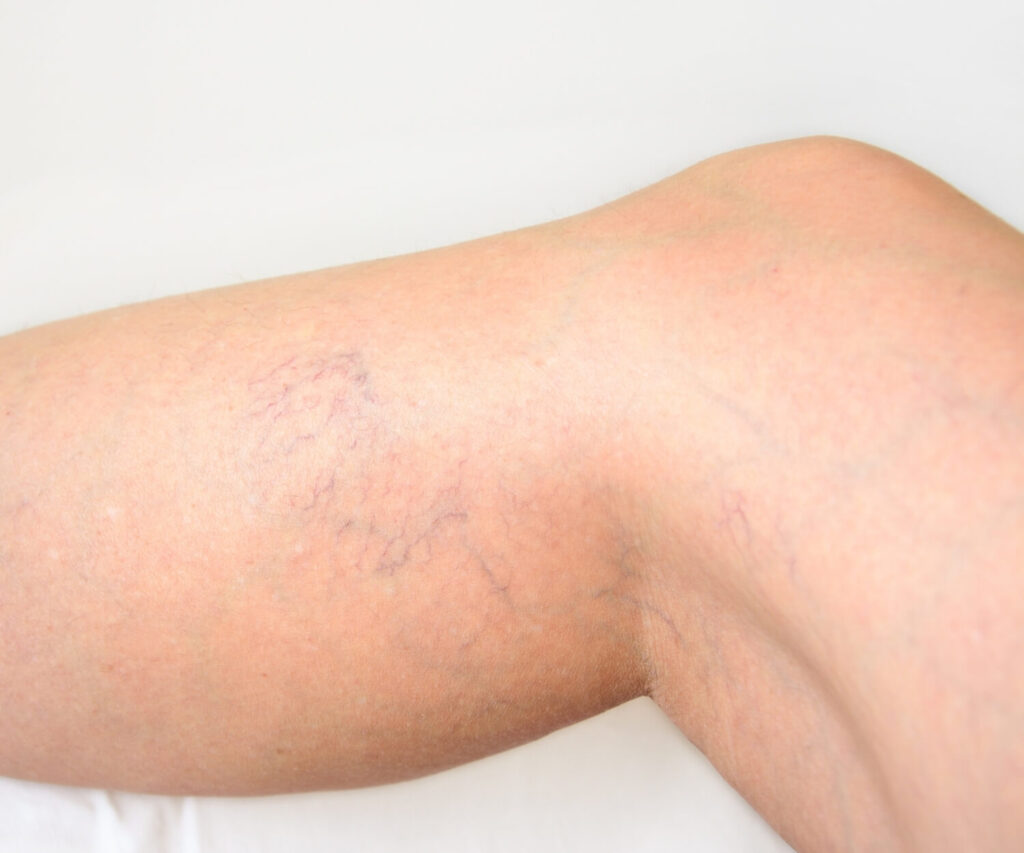 grochowska flebolo (1) flebolog