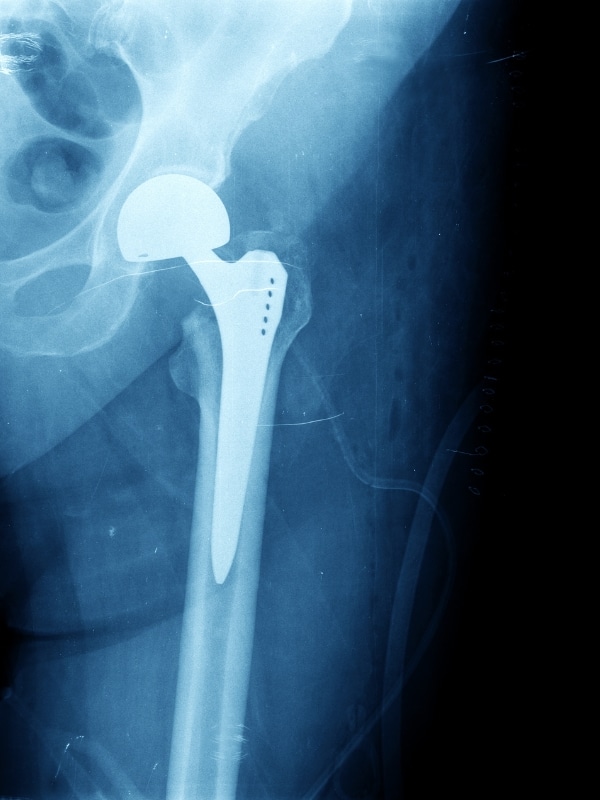 Endoproteza biodra Poznań (2)